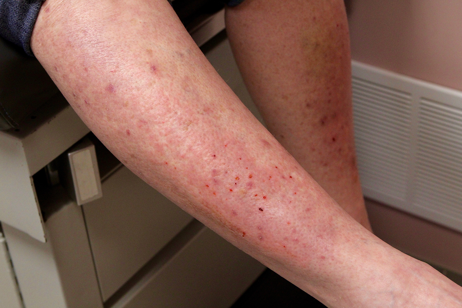 dermatitis-herpetiformis